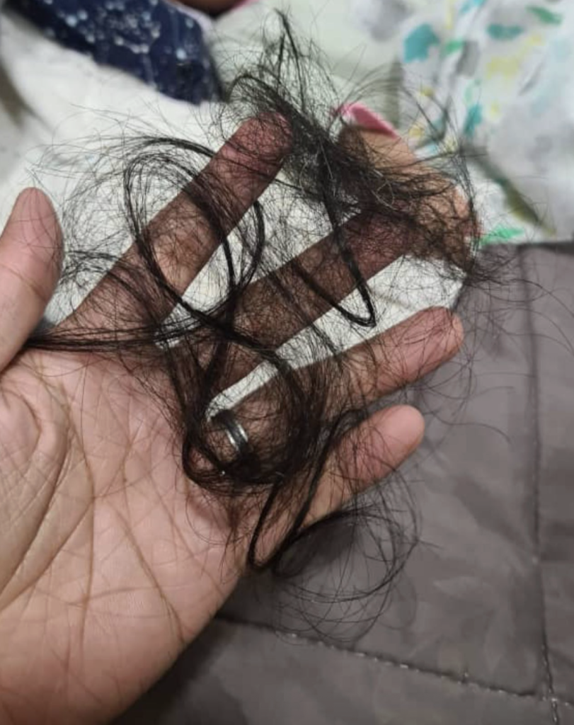 rambut gugur teruk